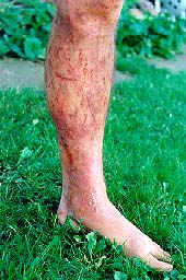 Wild parsnip burns on leg Wild parsnip burns on leg